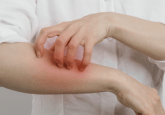 A person in a white shirt rolled up to their elbows scratches their forearm. Their skin is red where they are scratching. To represent that Lynx.MD and SDG partner to create RWD repository to enhance dermatology research.