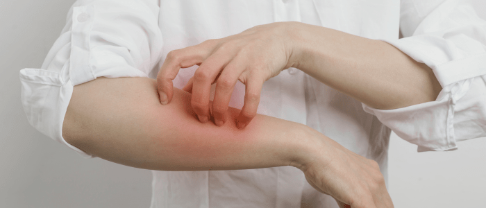 A person in a white shirt rolled up to their elbows scratches their forearm. Their skin is red where they are scratching. To represent that Lynx.MD and SDG partner to create RWD repository to enhance dermatology research.